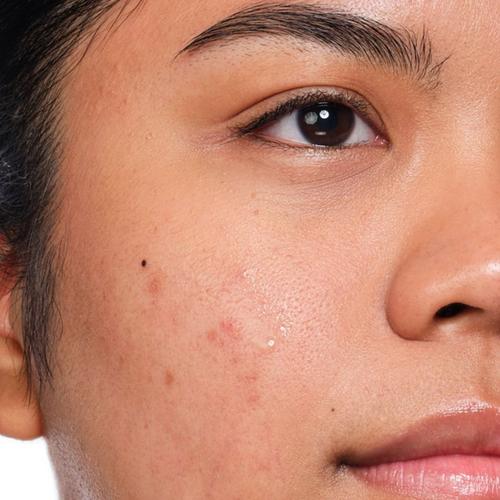 Congestion skincare concern
