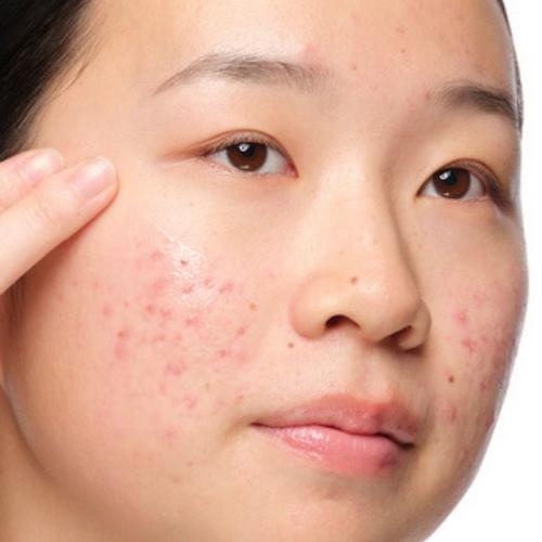 Redness skincare concern